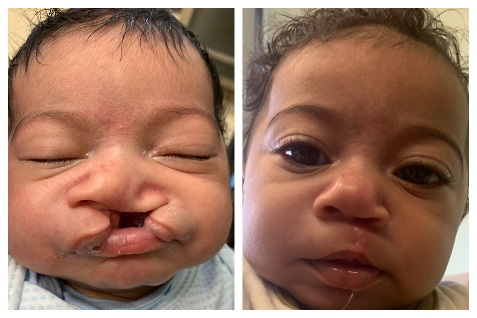 cleft lip and palate before and after