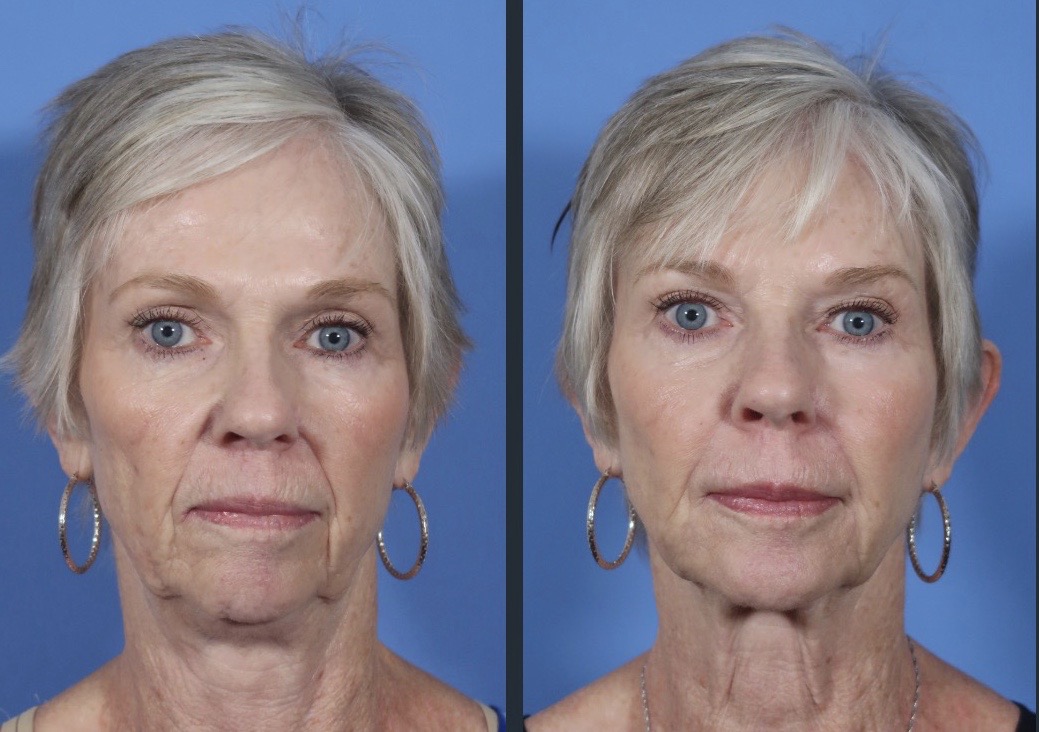 Liquid Facelift | Before & After Photos | Dr. Timothy Minton